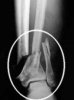broken-ankle.thumbnail1.jpg