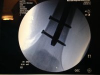 femur rod bottom.jpeg