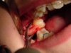 DentalSurgicalExtraction.jpg