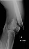 femur-fracture-2.jpg