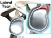 shoulder_labral_tear_intro01.jpg shoulder_labral_tear_intro01.jpg