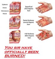 burn-classification.jpg